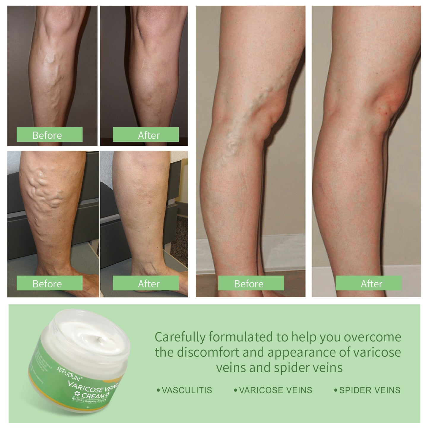 Vein Cream Red Blood Streaks Repair Earthworm Cream
